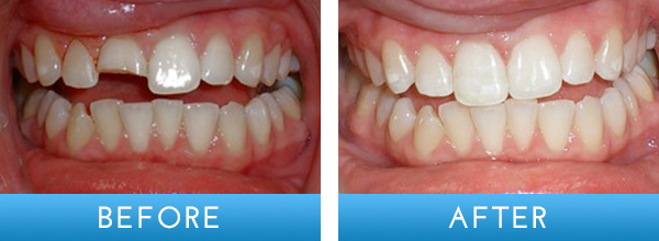 composite-fillings