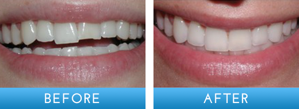 composite-fillings2