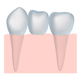 dental bridge - cosmetic dentistry - la mesa