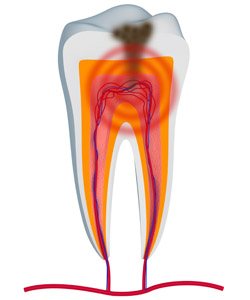 Root Canal Therapy in El Cajon, CA