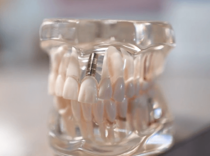 Dental Implants in La Mesa from cosmetic dentist Dr. Hagstrom